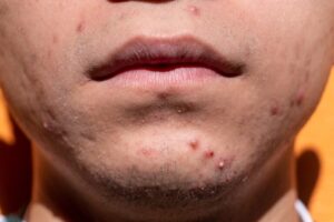 Cicatrices d’acné : causes et traitements