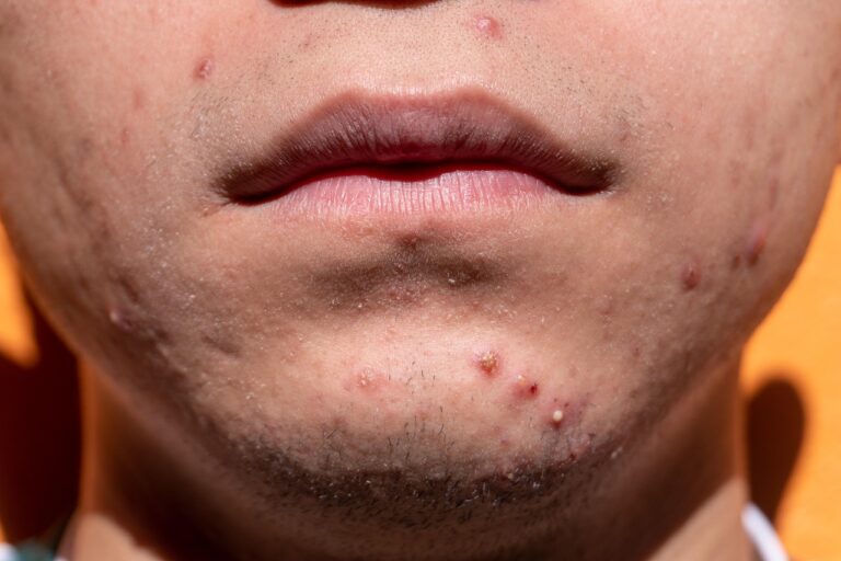 Cicatrices d’acné : causes et traitements