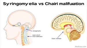 Syringomyélie et Chiari : Pourquoi ces deux affections sont différentes ?